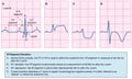 Normal and abnormal ecg traces Royalty Free Stock Photo