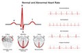 Normal and abnormal human heart beat rate infographic diagram Royalty Free Stock Photo