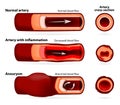 Normal artery, inflamed or narrowed artery and artery with an an Royalty Free Stock Photo