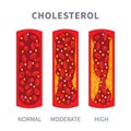Normal and blocked artery with cholesterol clot infographics