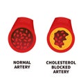 Normal and narrowed artery cross section illustration