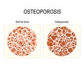 Normal bone and bone with osteoporosis Royalty Free Stock Photo