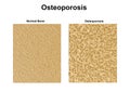 Normal bone structure density and with osteoporosis