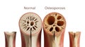 Normal Bone vs. Osteoporotic Bone Microstructure Comparison Royalty Free Stock Photo