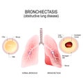 Normal bronchus and bronchiectasis. obstructive lung disease Royalty Free Stock Photo