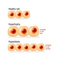 Normal cells, hypertrophy, and hyperplasia Royalty Free Stock Photo