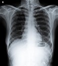 Normal Chest X Ray of human being.