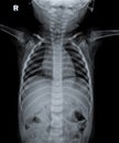 Normal Chest X Ray of human child. Royalty Free Stock Photo