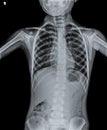 Normal Chest X Ray of human child. Royalty Free Stock Photo