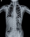 Normal Chest X Ray of human child. Royalty Free Stock Photo