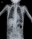 Normal Chest X Ray of human child. Royalty Free Stock Photo