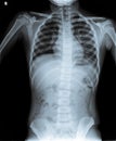 Normal Chest X Ray of human. Royalty Free Stock Photo