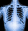 Normal Chest X Ray of human