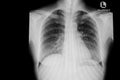 Normal chest x-ray image demonstrated heart,lungs,ribs,bones and muscles Royalty Free Stock Photo