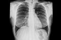 Normal chest x-ray image demonstrated heart,lungs,ribs,bones and muscles