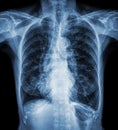 Normal chest X-ray of old patient . You can seen calcification at rib , trachea , bronchus . Front view Royalty Free Stock Photo