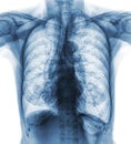 Normal chest X-ray of old patient . You can seen calcification at rib , trachea , bronchus . Front view Royalty Free Stock Photo
