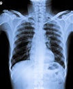 Normal Chest X Ray