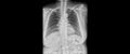 Normal chest x ray.Xray for diagnosis of pneumonia, tuberculosis TB and silicosis. Royalty Free Stock Photo