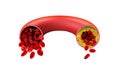 Normal and cholesterol-blocked artery on a white background.