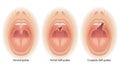 Normal and cleft palate