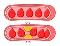 Normal and clogged blood vessels