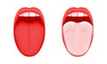 Normal and coated tongue. Dry mouth disease. Open human taste organ healthy and with symptoms of stomatitis, candidiasis