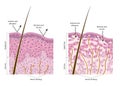 Normal and dry skin. Diagrame