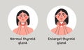 Normal and enlarget thyroid gland. Woman showing thyroid gland on her neck. Endocrinology system symbol, organ Royalty Free Stock Photo