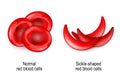 Normal erythrocytes and sickle-shaped red blood cells