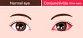 Normal eye and conjunctivitis pink eye vector illustration