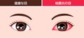 Normal eye and conjunctivitis pink eye vector illustration