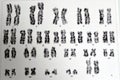 Normal female karyotyping, 46 XX, specimen collected from peripheral blood, a karyotype is the general appearance of the complete Royalty Free Stock Photo