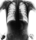 Normal film chest x-ray akimbo position front view Royalty Free Stock Photo