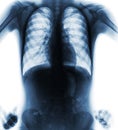 Normal film chest x-ray akimbo position front view