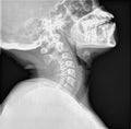 Normal film xray or radiograph of a cervical neck. Lateral extension view which is the best way to see Spondylolisthesis and to