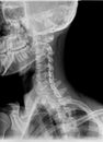 Normal film xray or radiograph of a cervical neck. Lateral slightly oblique view to see if any fracture of the pars inarticularis