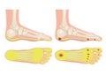 Normal foot and a foot with a fat pad atrophy / callus