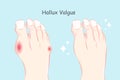 Normal foot and hallux valgus Royalty Free Stock Photo