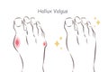 Normal foot and hallux valgus