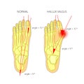 Normal foot and valgus deviation of the first toe with indicating of the deflection angles Royalty Free Stock Photo