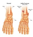 Normal and fractured ankle comparison