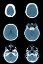 Normal head on CT scans