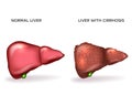 Normal healthy liver and Liver with Cirrhosis