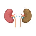 Normal healthy and unhealthy polycystic kidneys.