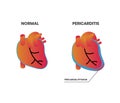 Normal heart anatomy vs pericarditis vector illustration Royalty Free Stock Photo