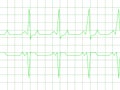 Normal Heart Rhythm