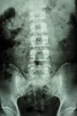 Normal human lumbar-sacrum spine Royalty Free Stock Photo