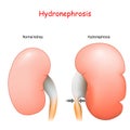 Normal human`s kidney and kidney affected by Hydronephrosis