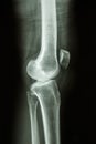 Normal human's knee joint